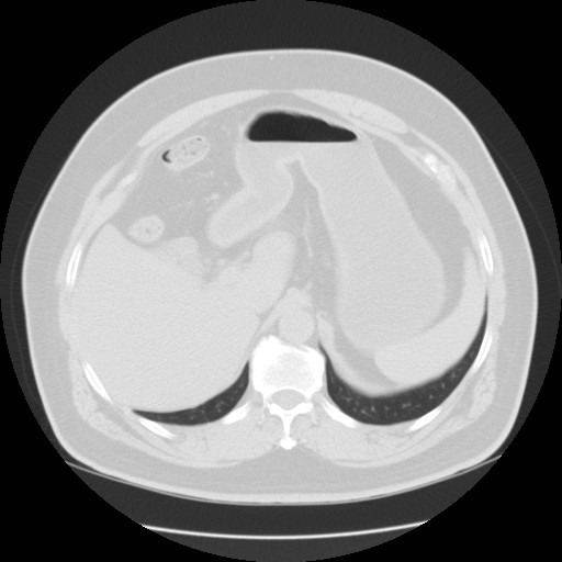 File:Chilaiditi’s syndrome (Radiopaedia 27550-27756 Axial lung window 25).jpg