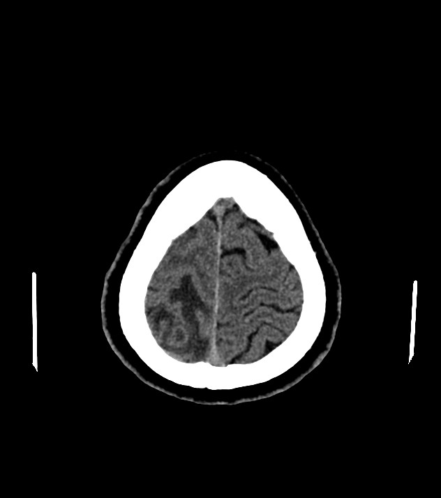 Cholangiocarcinoma with cerebral metastases (Radiopaedia 83519-98628 Axial non-contrast 57).jpg