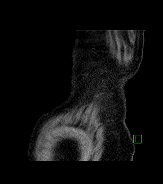 Cholangiocarcinoma with cerebral metastases (Radiopaedia 83519-98629 Sagittal C+ delayed 106).jpg