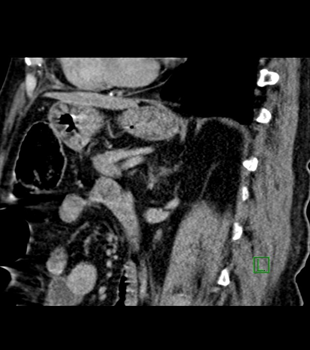 Cholangiocarcinoma with cerebral metastases (Radiopaedia 83519-98629 Sagittal C+ delayed 45).jpg