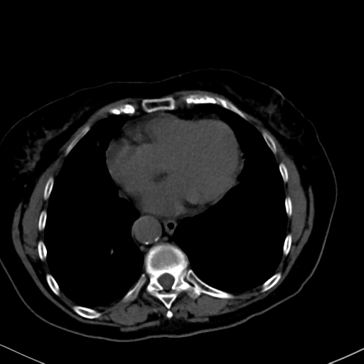 File:Cholecystitis - obstructive choledocholitiasis (CT intravenous cholangiography) (Radiopaedia 43966-47479 Axial 147).png