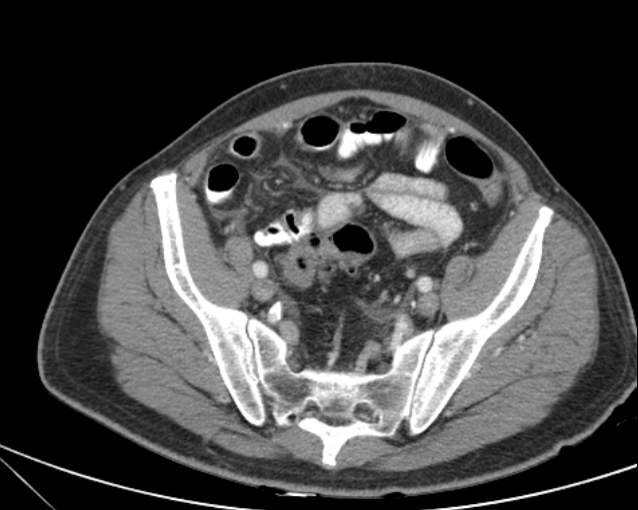 File:Cholecystitis - perforated gallbladder (Radiopaedia 57038-63916 A 66).jpg