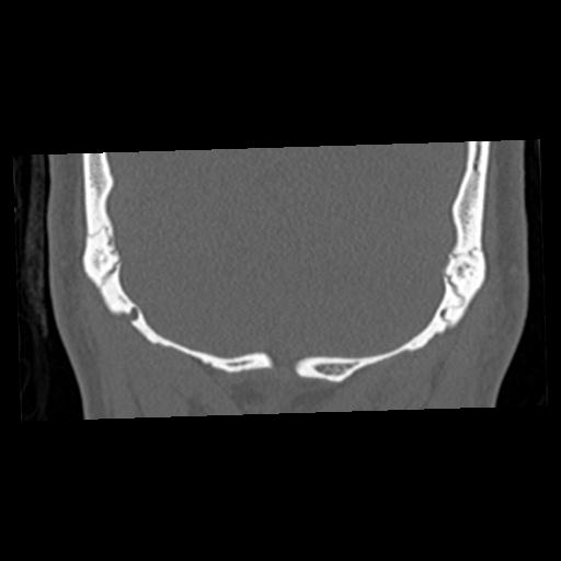File:Cholesteatoma (Radiopaedia 84960-100474 Coronal bone window 70).jpg