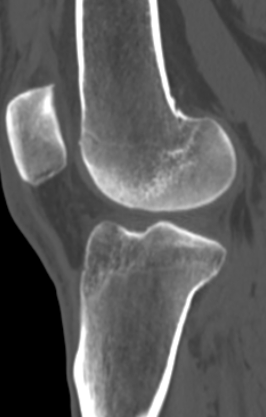 Chondrocalcinosis (Radiopaedia 82862-97173 Sagittal bone window 39).jpg