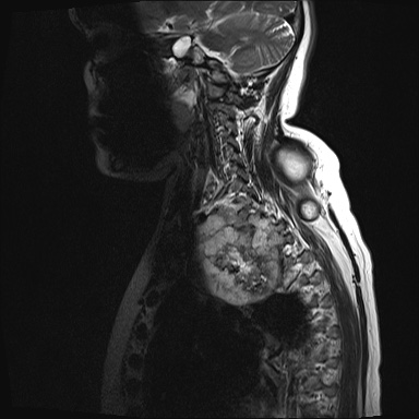 File:Chondrosarcoma - chest wall (Radiopaedia 65192-74200 Sagittal T2 13).jpg