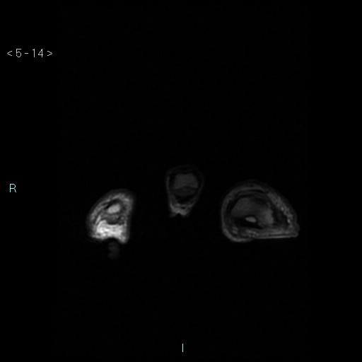 File:Chondrosarcoma - phalanx (Radiopaedia 69047-78813 Axial T1 14).jpg