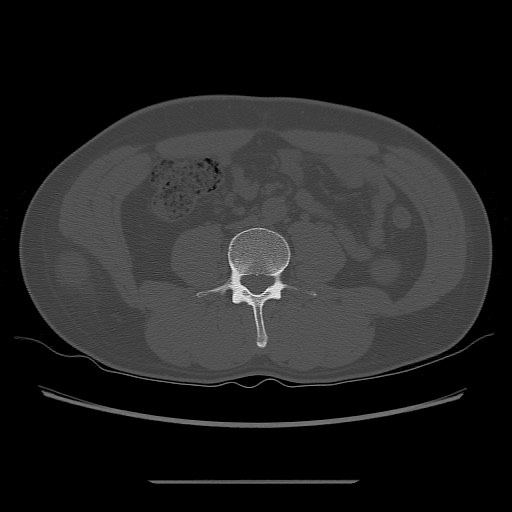 File:Chondrosarcoma of iliac wing (Radiopaedia 63861-72599 Axial bone window 9).jpg