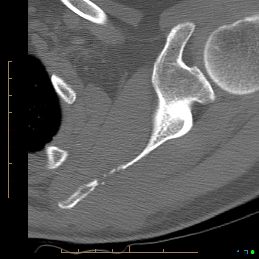 File:Chondrosarcoma of the scapula (Radiopaedia 30696-31399 Axial non-contrast 6).jpg