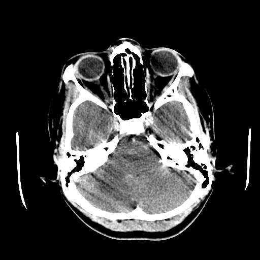 File:Choriocarcinoma of ovary with cerebral and pulmonary metastases (Radiopaedia 25983-26118 C+ arterial phase 34).jpg