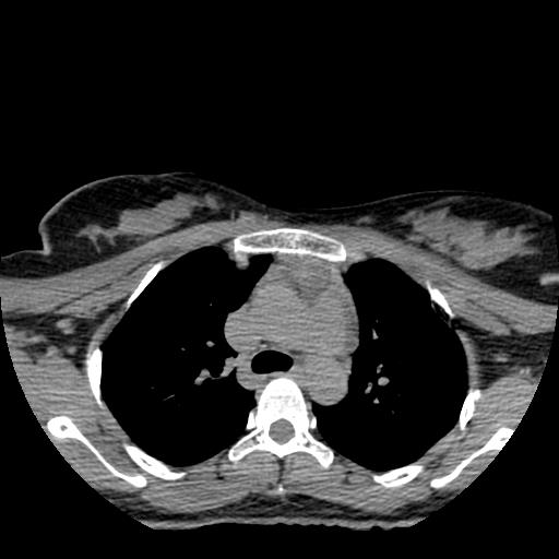 File:Choriocarcinoma of ovary with cerebral and pulmonary metastases (Radiopaedia 25983-26119 Axial non-contrast 113).jpg