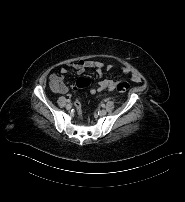 Chromophobe renal cell carcinoma (Radiopaedia 84239-99519 E 120).jpg