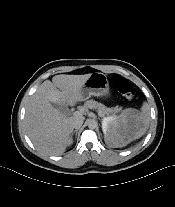 Chromophobe renal cell carcinoma (Radiopaedia 84255-99542 H 5).jpg