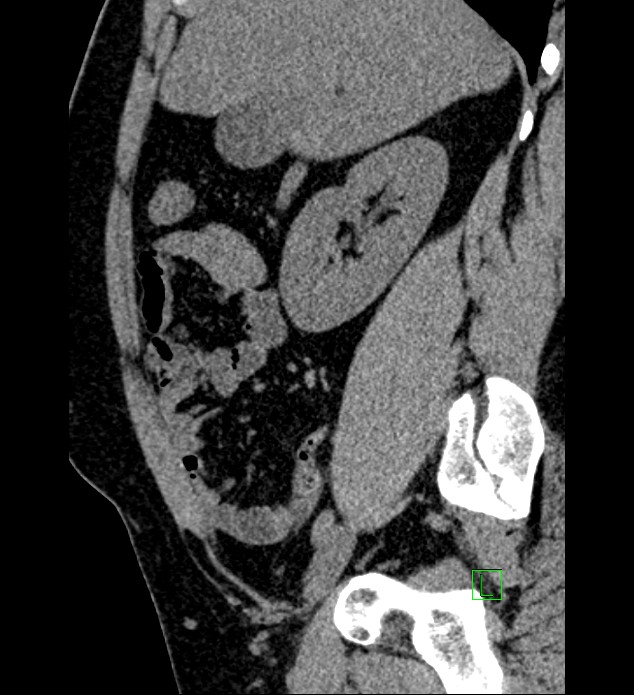 Chromophobe renal cell carcinoma (Radiopaedia 84286-99573 C 125).jpg