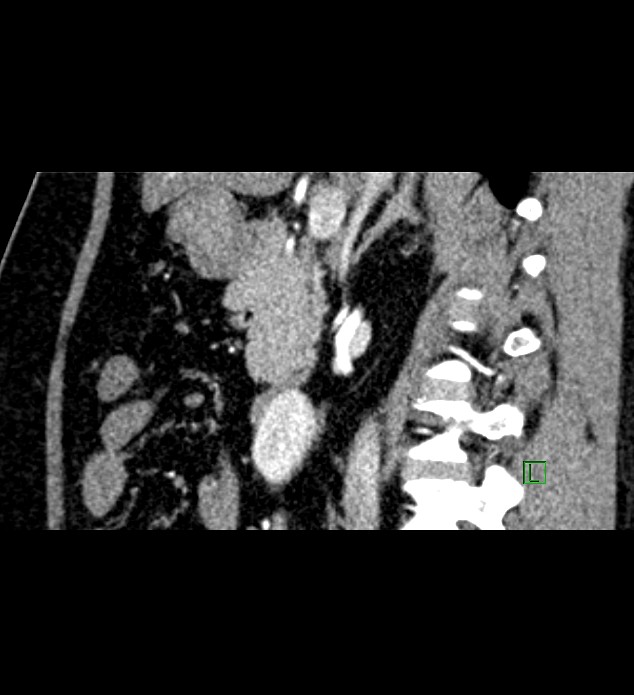 Chromophobe renal cell carcinoma (Radiopaedia 84286-99573 F 99).jpg