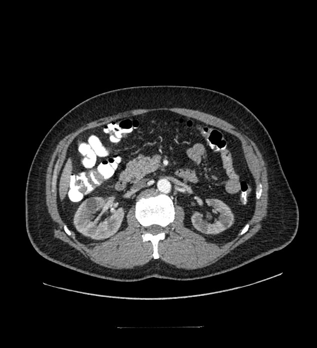 Chromophobe renal cell carcinoma (Radiopaedia 84337-99644 B 41).jpg