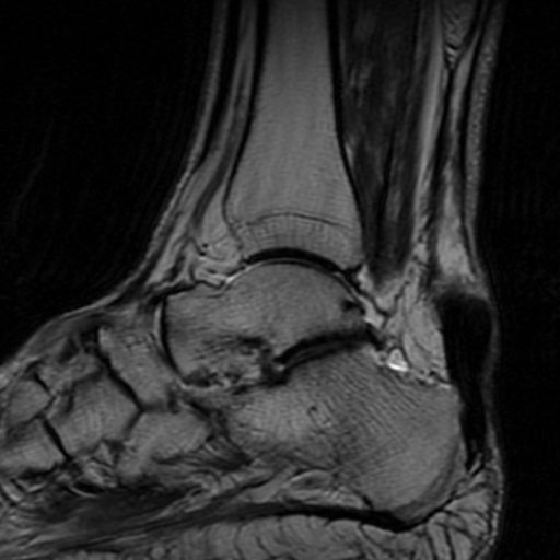 File:Chronic Achilles tendon rupture (Radiopaedia 15262-15100 Sagittal T2 7).jpg