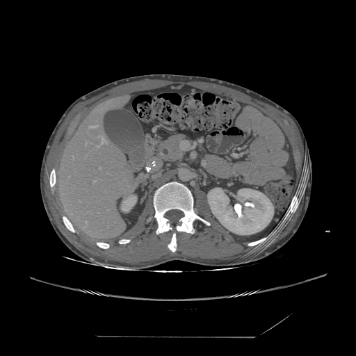 File:Chronic IVC thrombosis and resultant IVC filter malposition (Radiopaedia 81158-94800 A 68).jpg