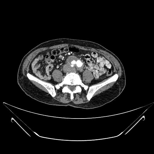File:Chronic contained rupture of abdominal aortic aneurysm with extensive erosion of the vertebral bodies (Radiopaedia 55450-61901 A 45).jpg