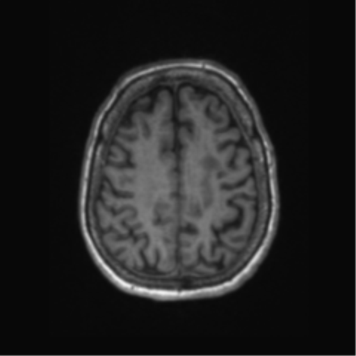 Chronic hypertensive encephalopathy (Radiopaedia 72844-83495 Axial T1 20).png