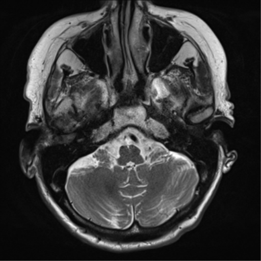 File:Chronic hypertensive encephalopathy (Radiopaedia 72844-83495 Axial T2 7).png