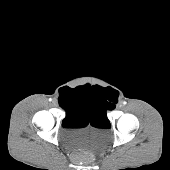 Chronic large bowel pseudo-obstruction (Radiopaedia 43181-46492 A 153).jpg