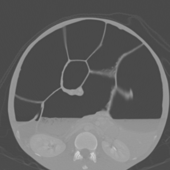 Chronic large bowel pseudo-obstruction (Radiopaedia 43181-46492 Axial bone window 85).jpg