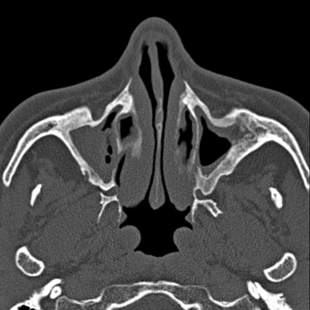 Chronic maxillary sinusitis (Radiopaedia 27879-28116 Axial bone window 16).jpg