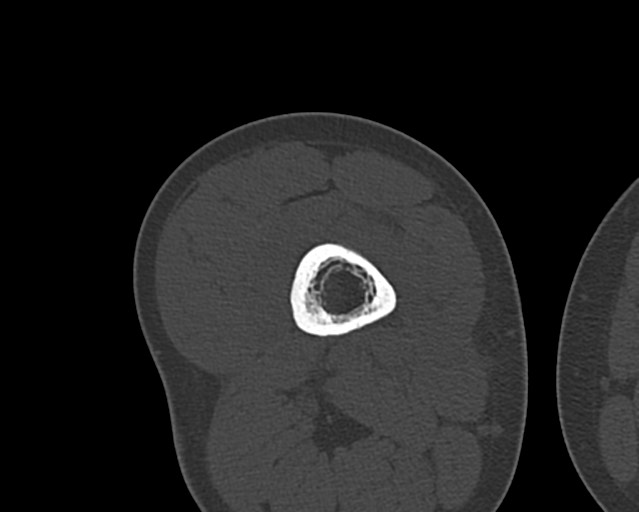 Chronic ostemyelitis of the femur with long sinus tract (Radiopaedia 74947-85982 Axial bone window 121).jpg