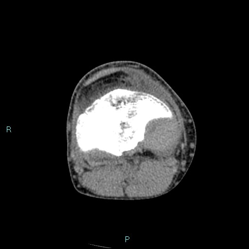 File:Chronic osteomyelitis (with Brodie abscess) (Radiopaedia 76405-88111 A 107).jpg
