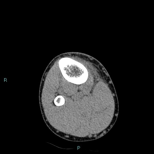 Chronic osteomyelitis (with Brodie abscess) (Radiopaedia 76405-88111 A 51).jpg