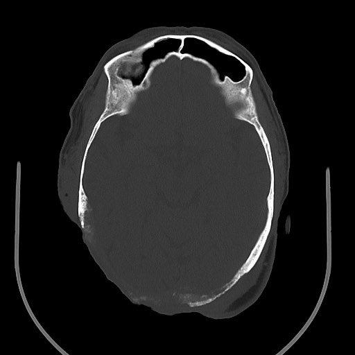 Chronic osteomyelitis - calvarial (severe) (Radiopaedia 69668-79616 Axial bone window 41).jpg