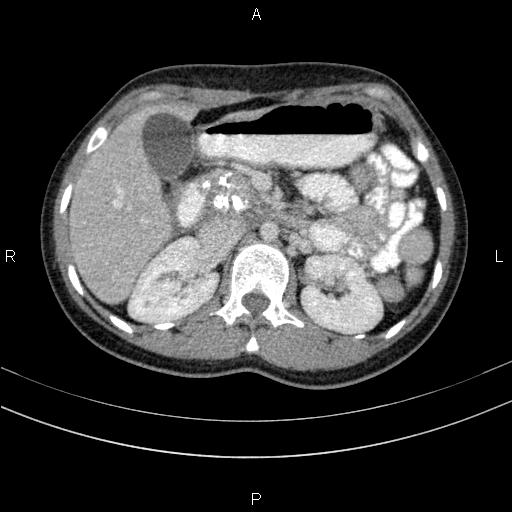 File:Chronic pancreatitis (Radiopaedia 64576-73450 C 53).jpg