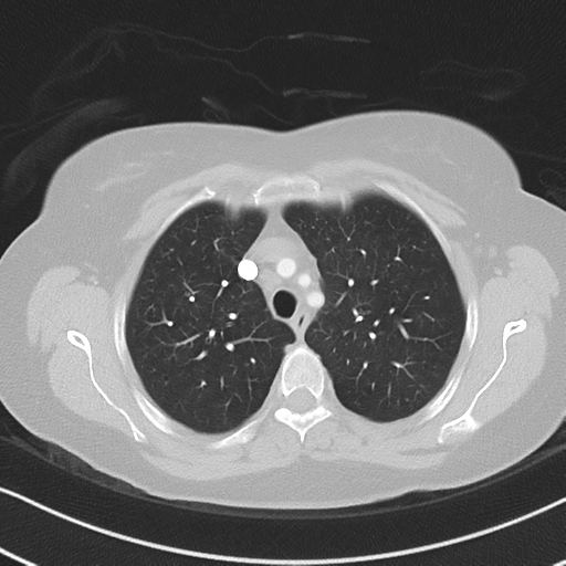 Chronic pulmonary embolus (Radiopaedia 39129-41341 Axial lung window 18).png