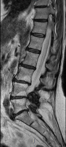 File:Chronic spinal hematoma with cauda equina syndrome (Radiopaedia 75745-87090 Sagittal T2 6).png