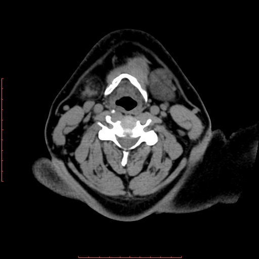 Chronic submandibular sialolithiasis (Radiopaedia 69817-79814 Axial non-contrast 143).jpg