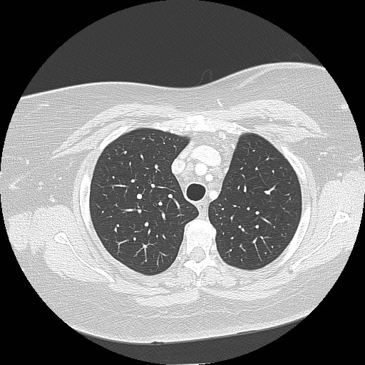 Cicatrisation collapse (Radiopaedia 17405-17089 lung window 29).jpg