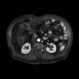 File:Cirrhosis and hepatocellular carcinoma in the setting of hemochromatosis (Radiopaedia 75394-86594 Axial T1 C+ fat sat 105).jpg