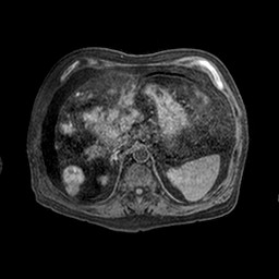 Cirrhosis and hepatocellular carcinoma in the setting of hemochromatosis (Radiopaedia 75394-86594 Axial T1 C+ fat sat 47).jpg