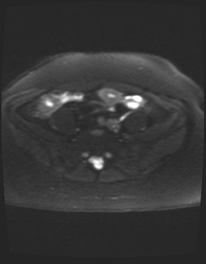 File:Class II Mullerian duct anomaly- unicornuate uterus with rudimentary horn and non-communicating cavity (Radiopaedia 39441-41755 Axial DWI 4).jpg