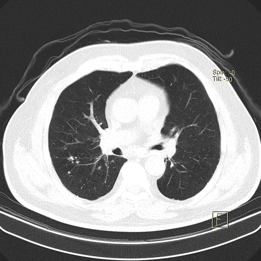 Classic complicated silicosis (Radiopaedia 49720-54961 Axial lung window 27).jpg