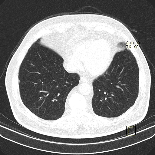 Classic complicated silicosis (Radiopaedia 49720-54961 Axial lung window 43).jpg