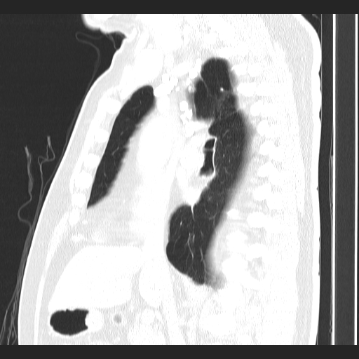 Classic complicated silicosis (Radiopaedia 49720-54961 Sagittal lung window 36).jpg
