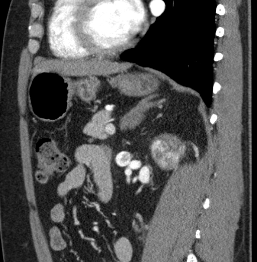 File:Clear cell renal cell carcinoma (Radiopaedia 61449-69393 D 40).jpg