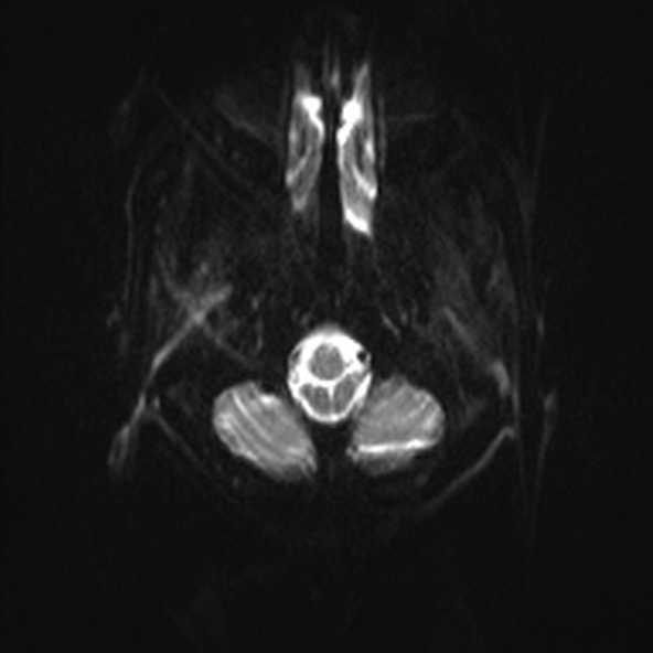 File:Clival meningioma (Radiopaedia 53278-59248 Axial DWI 1).jpg