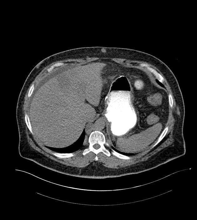Closed-loop small bowel obstruction-internal hernia (Radiopaedia 78439-91096 Axial non-contrast 31).jpg