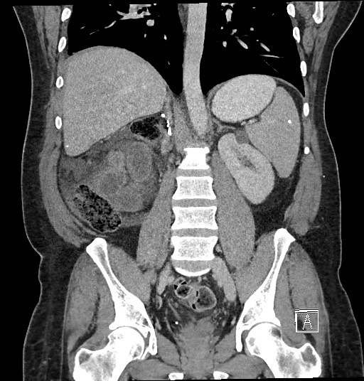 File:Closed loop obstruction - internal hernia into nephrectomy bed (Radiopaedia 59867-67320 B 88).jpg