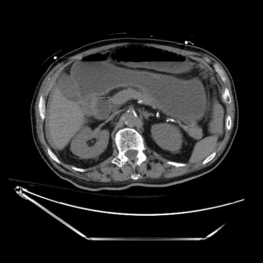 Closed loop obstruction due to adhesive band, resulting in small bowel ischemia and resection (Radiopaedia 83835-99023 Axial non-contrast 52).jpg