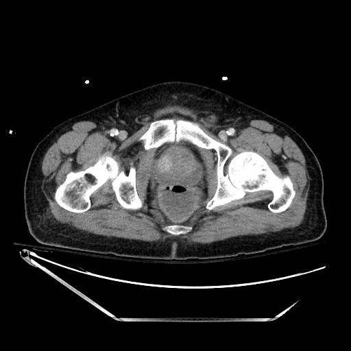 File:Closed loop obstruction due to adhesive band, resulting in small bowel ischemia and resection (Radiopaedia 83835-99023 D 152).jpg