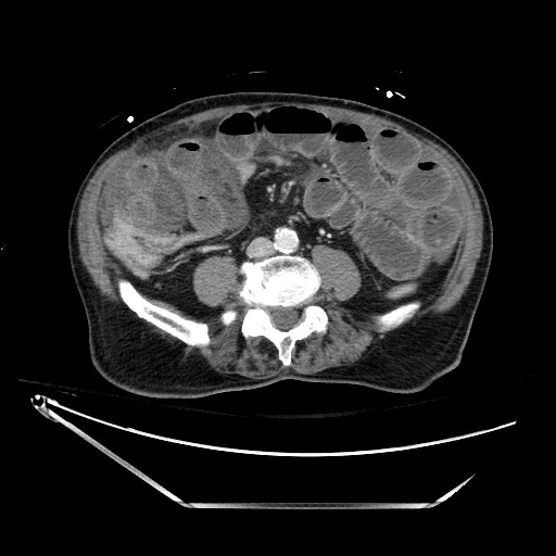 File:Closed loop obstruction due to adhesive band, resulting in small bowel ischemia and resection (Radiopaedia 83835-99023 D 93).jpg