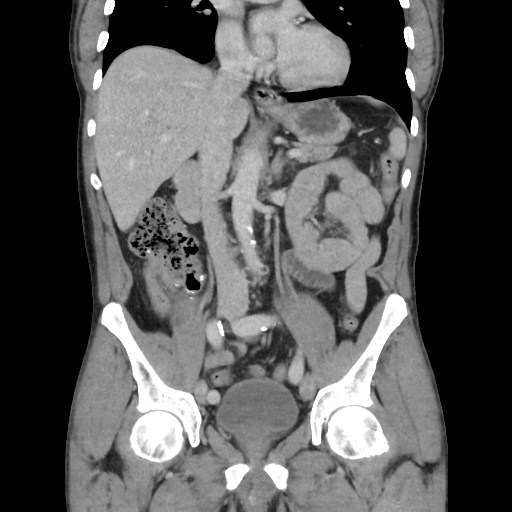 File:Closed loop small bowel obstruction (Radiopaedia 59227-66554 B 25).jpg